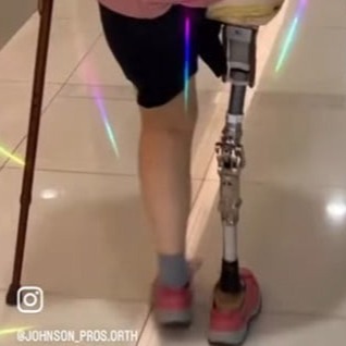髖關節義肢 